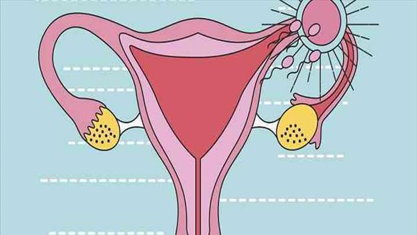 多囊卵巢怎么锻炼身体